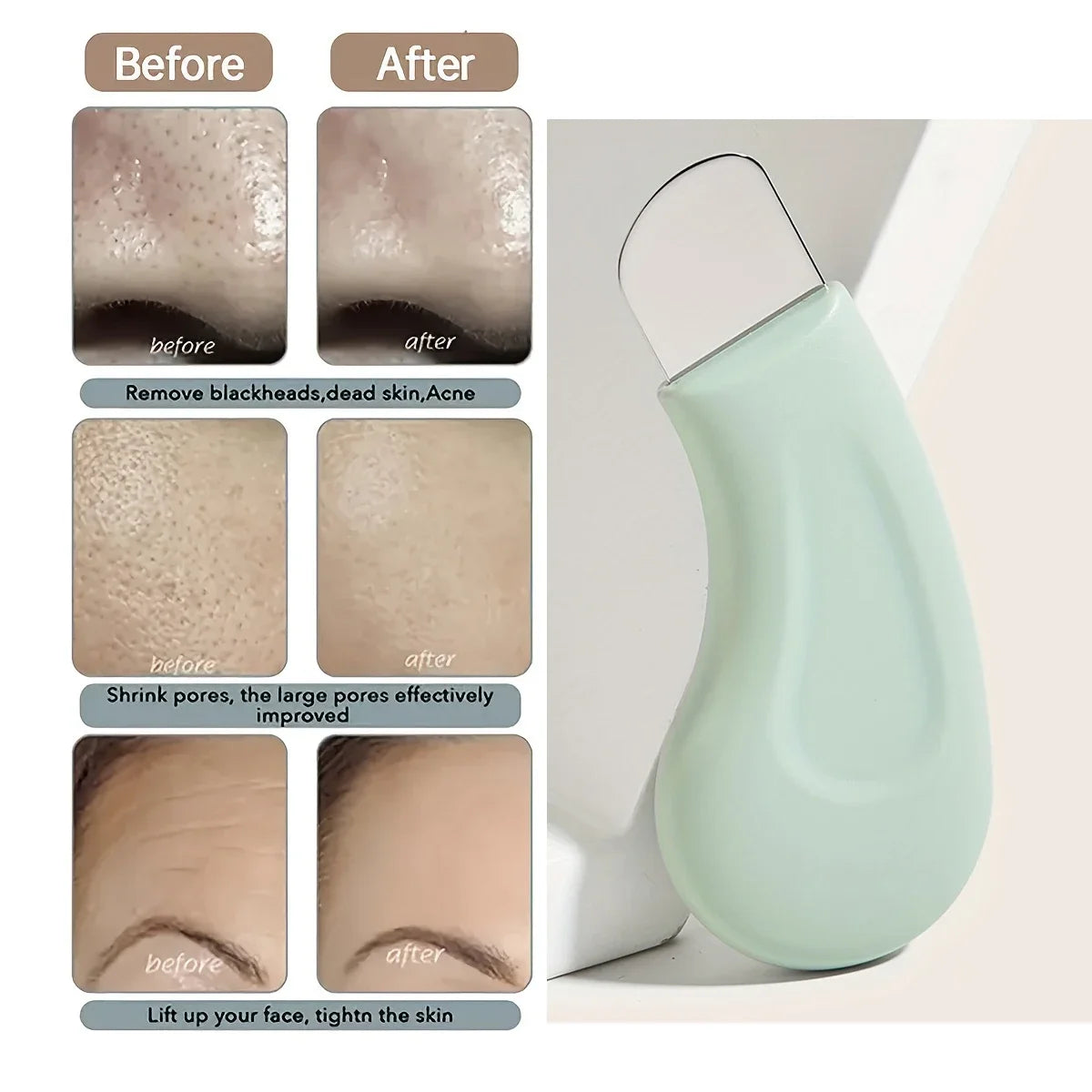✨ Extractor de Puntos Negros y Limpiador de Poros Facial